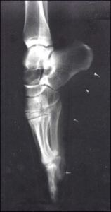 X-ray of foot on pointe for Leica Hardy School of Dance Words to Dance By blog post 'When to Start Pointe'.